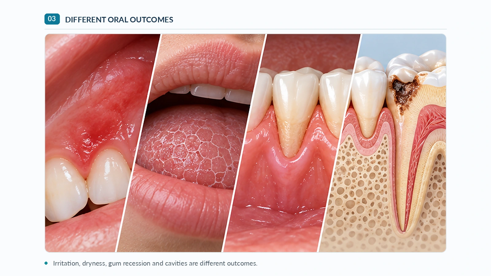 Different oral health outcomes illustrated Comparison illustrating mouth irritation, dry mouth, gum recession and tooth decay as distinct oral health outcomes